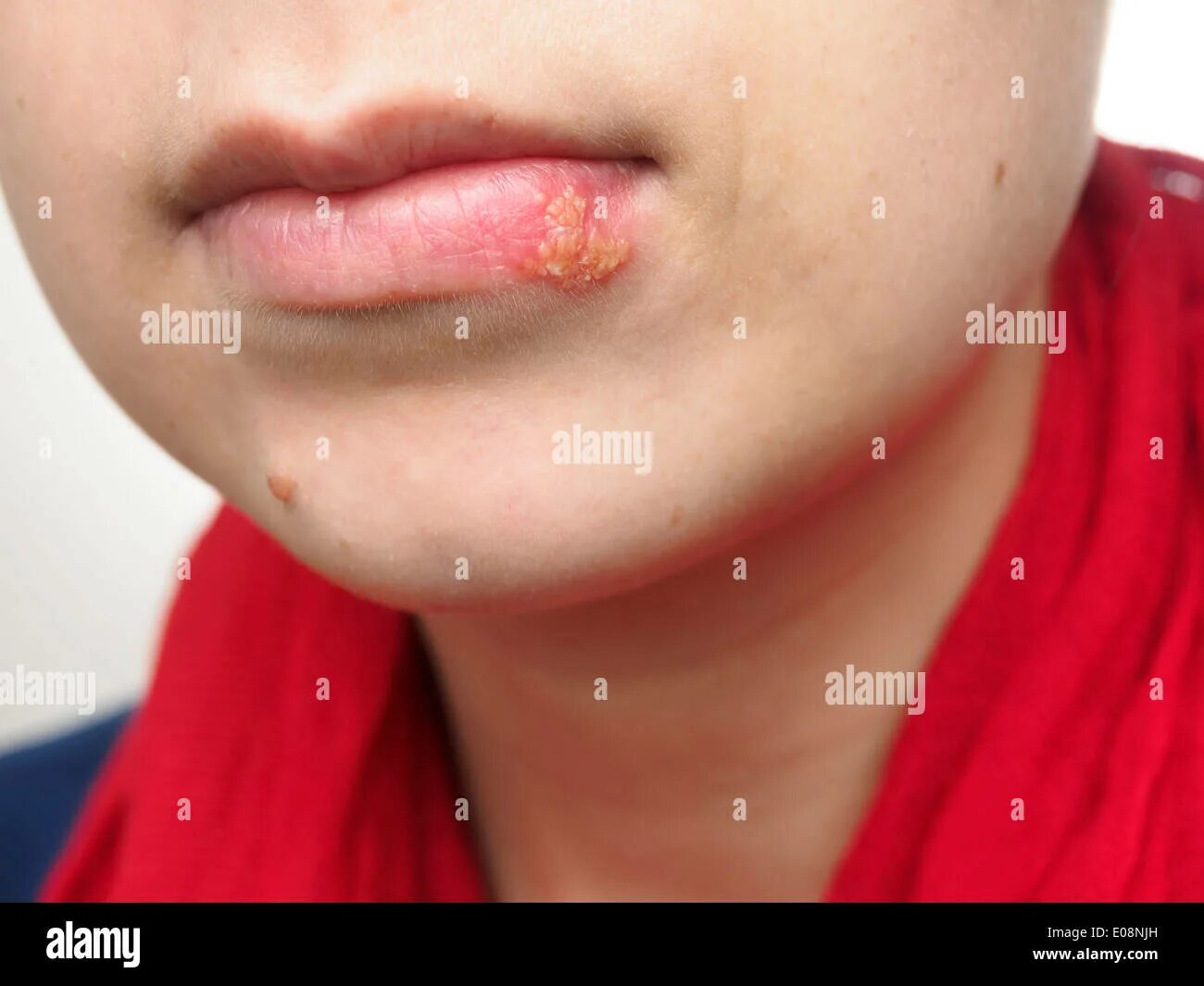 Пузырьковый герпес фото Junge Frau mit Herpes-Simplex-Infektion an Unterlippe Stockfotografie - Alamy