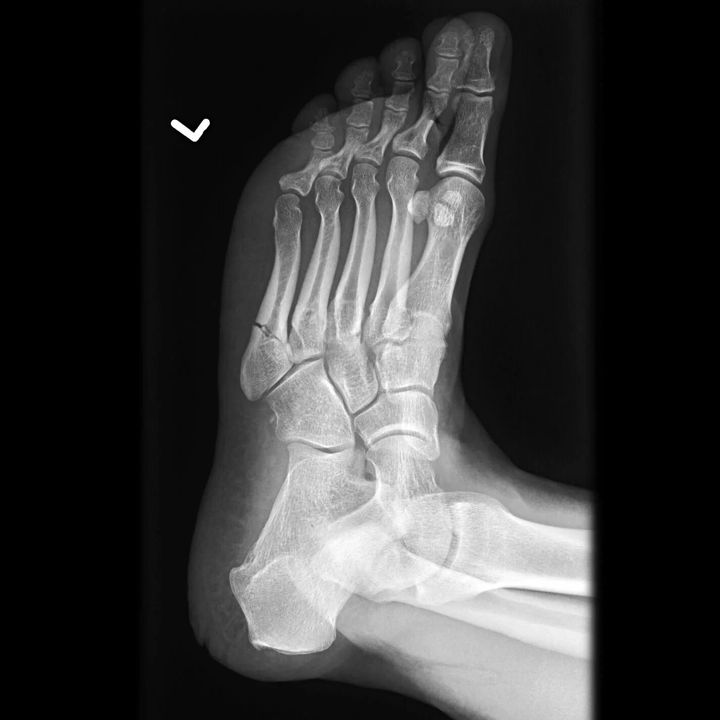 Пятая кость стопы фото Jones fracture Image Radiopaedia.org