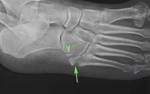 Пятая кость стопы фото Рентген стопы - фото, показания и проведение