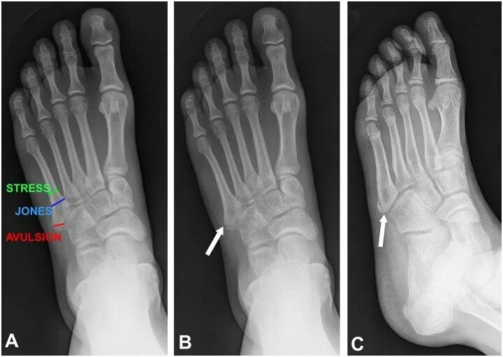 Пятая кость стопы перелом фото Fractures of the fifth metatarsal base. Frontal radiograph (A)... Download Scien