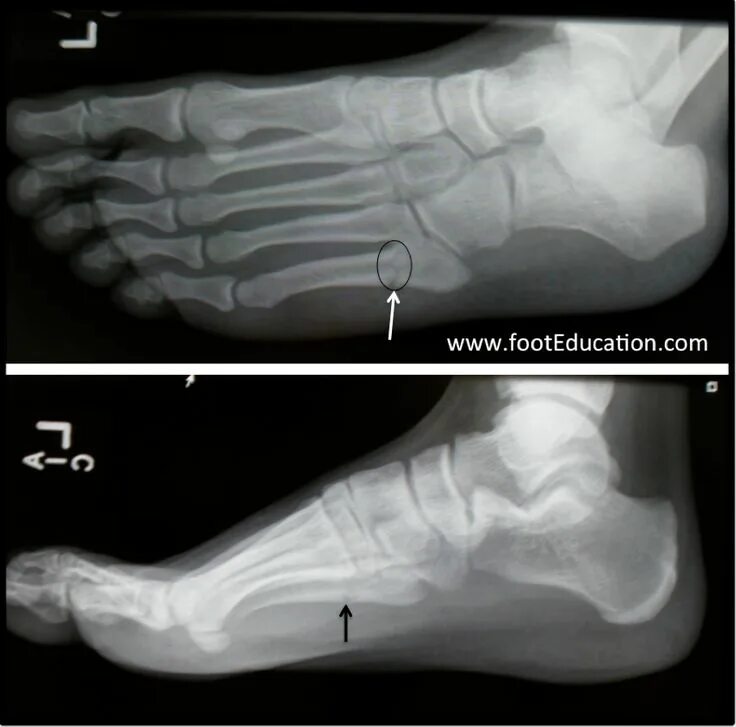 Пятая кость стопы перелом фото 5th Metatarsal Base Fractures - FootEducation Avulsion fracture, Metatarsal frac