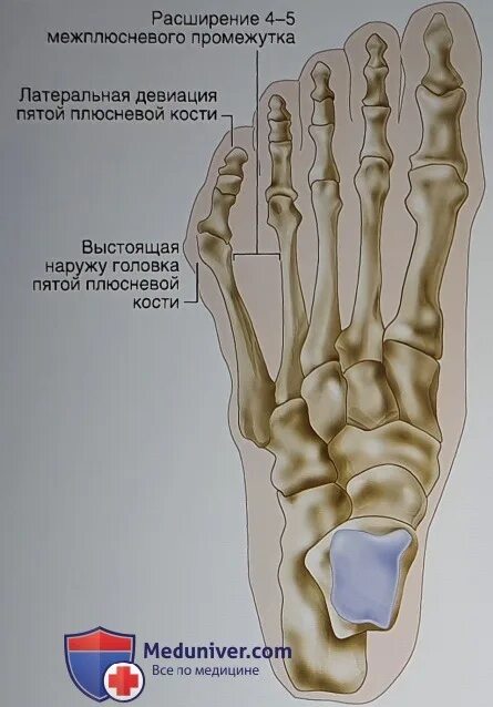 Пятая плюсневая кость фото Показания для остеотомии пятой плюсневой кости при варусной деформации пятого па