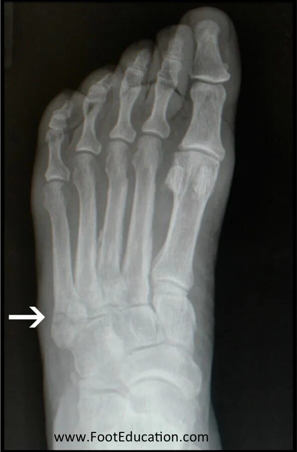 Пятая плюсневая кость фото Jones Fracture - FootEducation Avulsion fracture, Jones fracture, Metatarsal fra