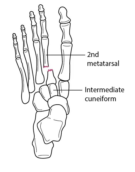 Пятая плюсневая кость где находится фото Table: Fracture of the 2nd metatarsal base with tarsometatarsal joint dislocatio