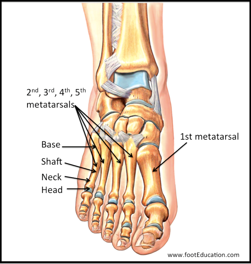 Пятая плюсневая кость где находится фото Metatarsal Fractures OrthoPaedia Header