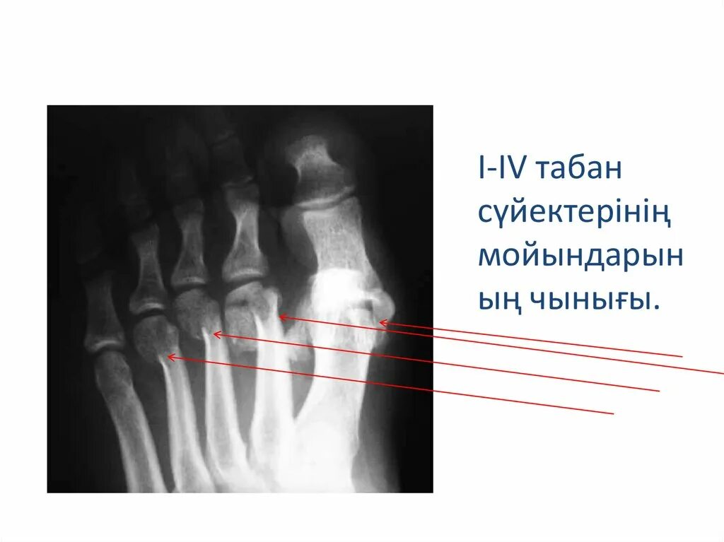 Пятая плюсневая кость где находится фото перелом Аяқ сүйектерінің жарақаттары - презентация онлайн