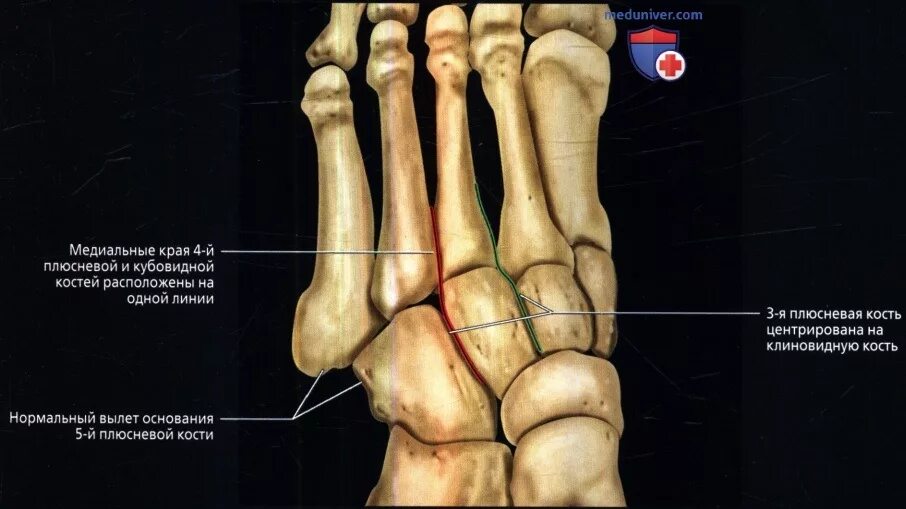 Пятая плюсневая кость стопы фото Размеры и линии стопы, голеностопного сустава
