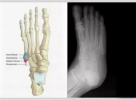 Пятая плюсневая кость стопы где находится фото Пятой Плюсневой Кости Стопы Фото - Telegraph