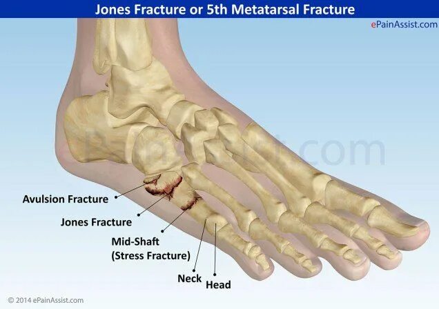 Пятая плюсневая кость стопы где находится фото jones fractuur - Yahoo Image Search Results