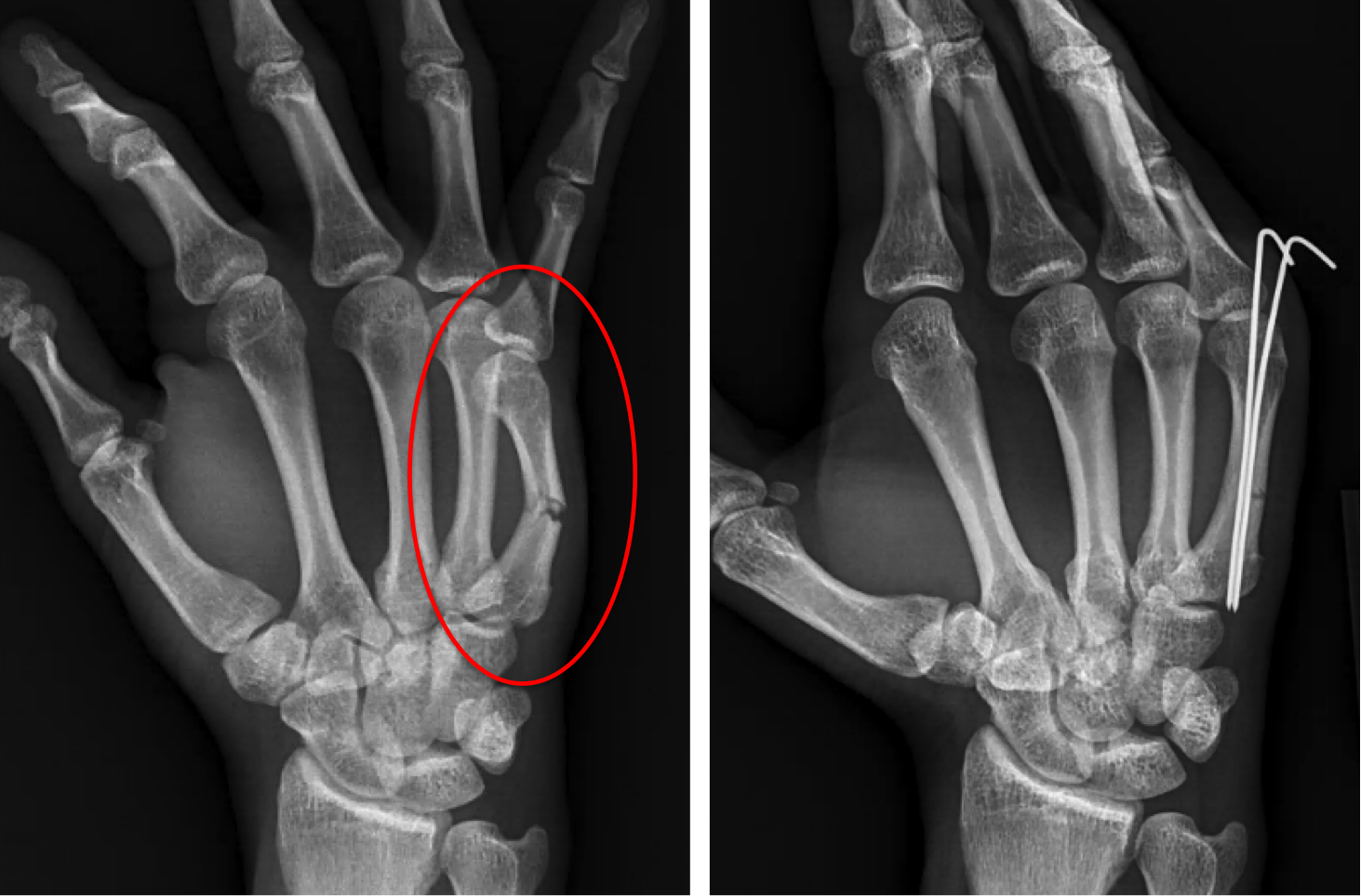 Пятая пястная кость фото Hand Fracture - Raleigh Hand Surgery - Joseph J. Schreiber, MD