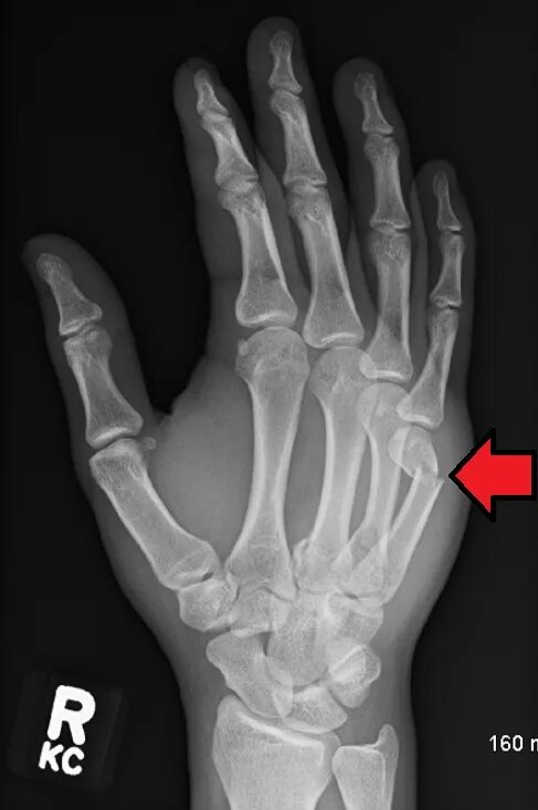 Пятая пястная кость фото Boxer's fracture - Wikipedia