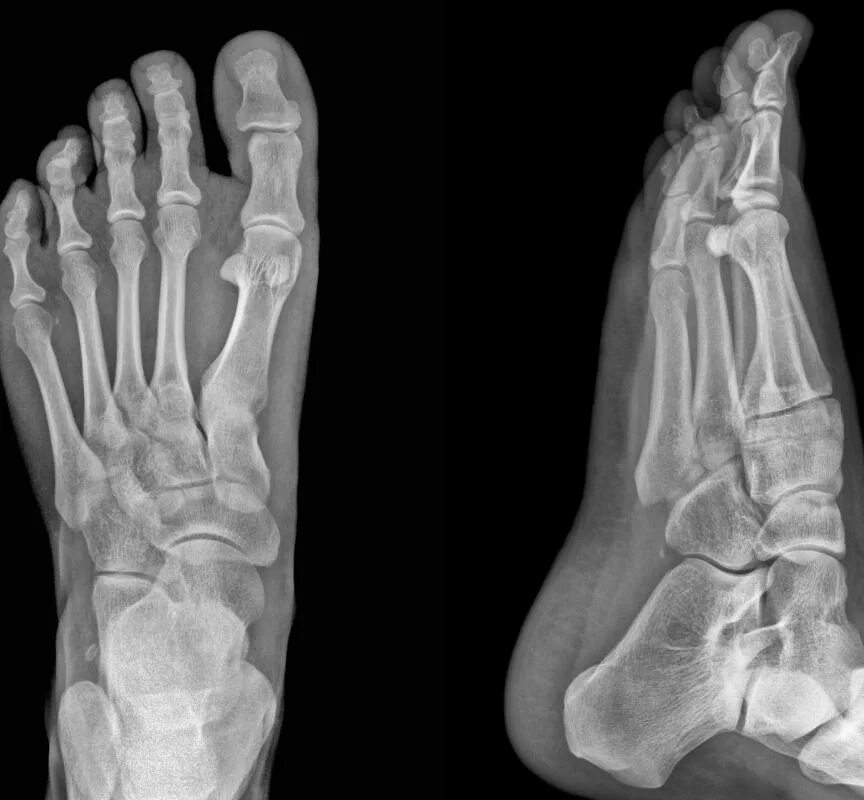 Пятка кость фото What is the Calcaneus? (with pictures)