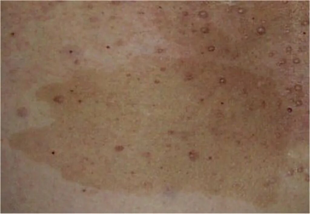 Пятна кофе с молоком фото CAFÉ AU LAIT LESIONS - Dermatology Conditions and Treatments