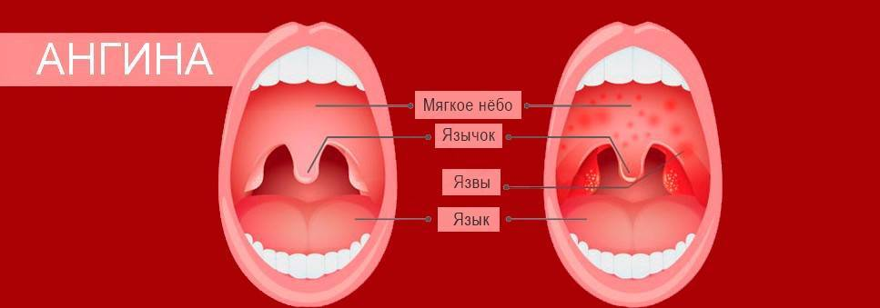 Пятна на горле у ребенка фото Летняя ангина у ребенка - в чем причины воспаления и несколько опасна болезнь О 