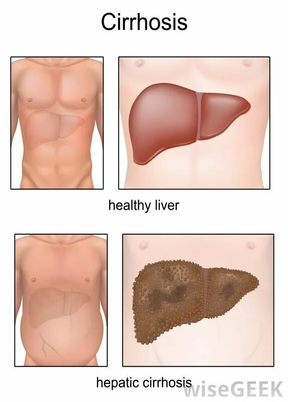 Пятна на коже при болезни печени фото Pin on Med-Surg: Exam 3