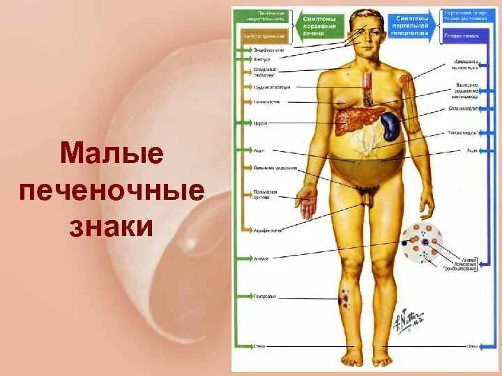 Пятна на ладонях при циррозе печени фото Покраснение ладоней при циррозе печени фото - ViktoriaFoto.ru