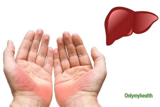 Пятна на ладонях при циррозе печени фото Red Palms Liver Disease Photos