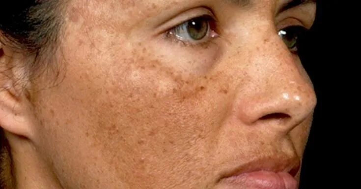 Пятна на лице от печени фото Pin on Hyperpigmentation