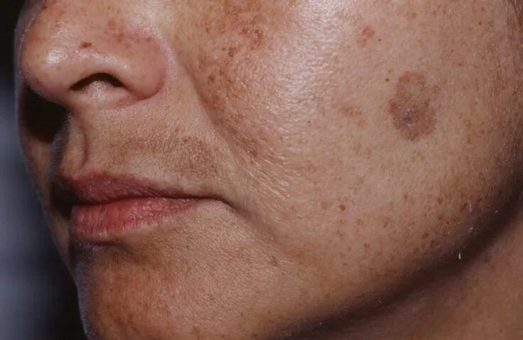 Пятна на лице после алкоголя фото Slavens dermatologs parādīja, kā atbrīvoties no brūnajiem pleķiem uz sejas ādu a