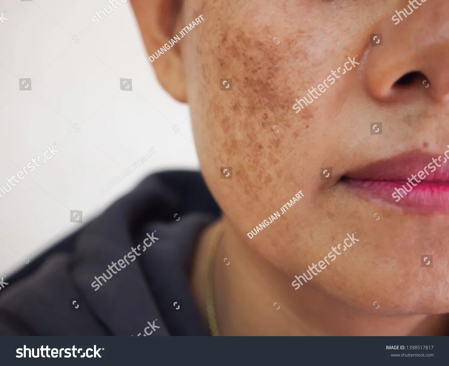 Пятна на лице после алкоголя фото 6.599 Dark spot on face Gambar, Foto Stok & Vektor Shutterstock