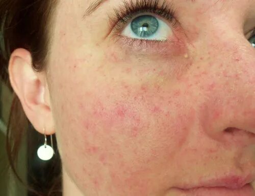 Пятна на лице после алкоголя фото Little Red Dots Around Eyes After Throwing Up - Release Date Price Reviews