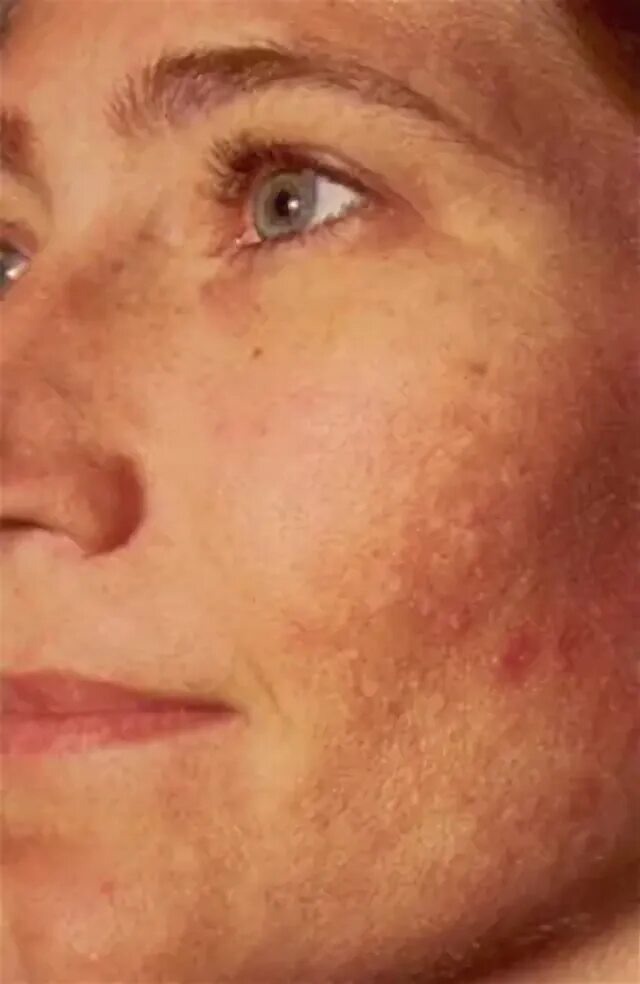 Пятна на лице при болезни печени фото Melasma: más allá de una simple mancha MSC Noticias