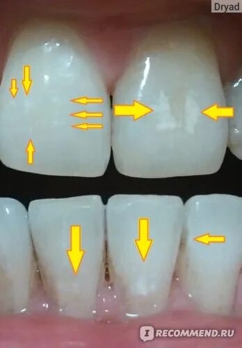 Пятна на зубах фото Гель стоматологический Regenerate Enamel Science Boosting SERUM Kit - "Ого, само