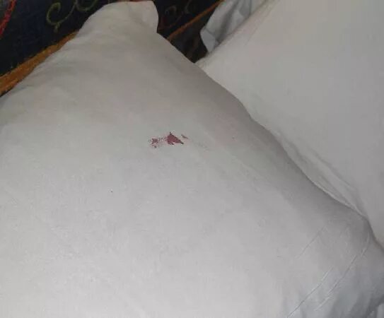 Пятна от укусов фото Blood stained pillow - Picture of Hotel BelleVue Aquarius, Lanzarote - Tripadvis