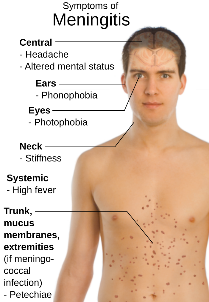 Пятнистая сыпь при вич фото File:Symptoms of Meningitis.svg - Wikipedia