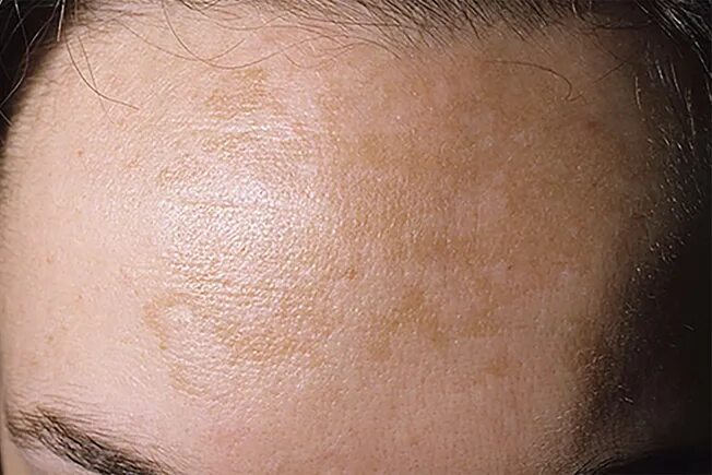 Пятно на лице коричневого цвета фото Sun Damaged Skin: Sunburn, Melanoma, Carcinoma, and More