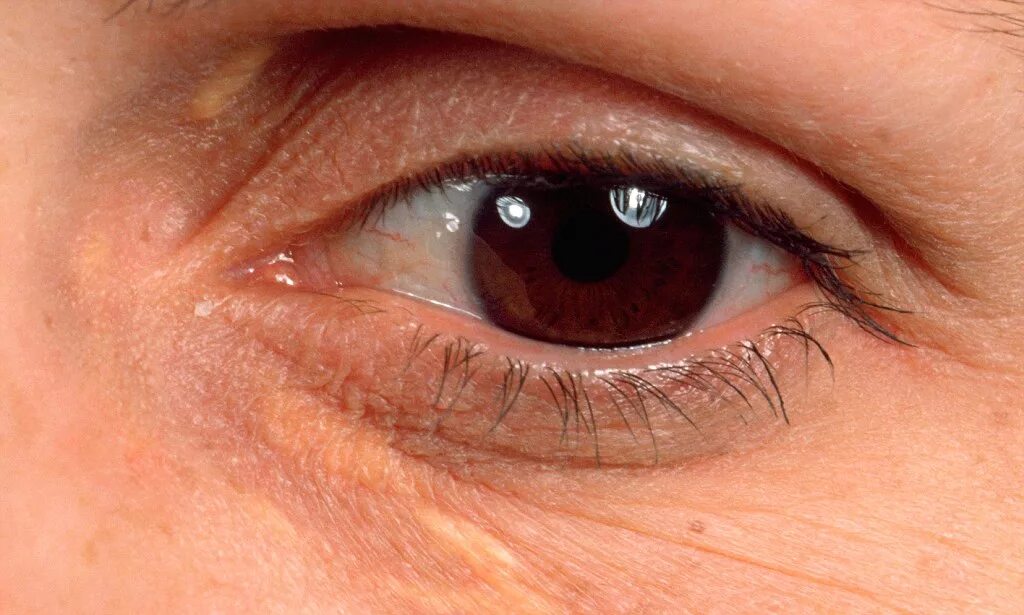 Пятно под глазом фото Yellow eyelid marks (xanthelasma) 'early warning sign of heart disease'