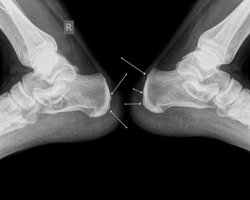 Пяточная кость фото Рентген 2015