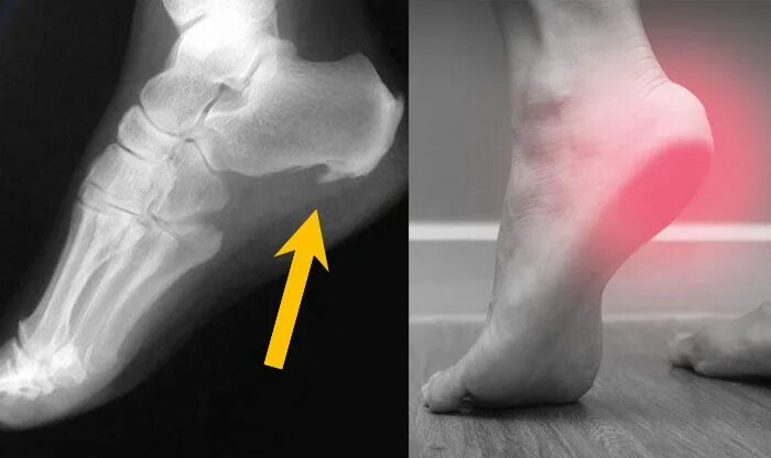 Пяточная кость фото Pin by Neja Koretič on Manualna Calcaneal spur, Calcaneal spur treatment, Heel s