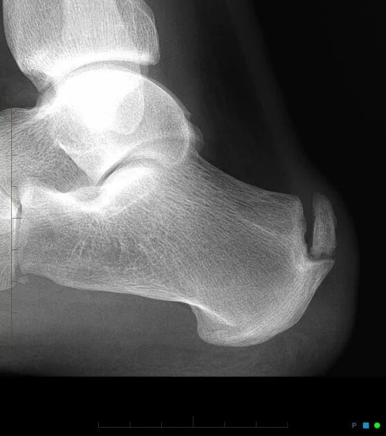 Пяточная кость фото как выглядит у человека Insertional Achilles calcific spur Radiology Case Radiopaedia.org Radiology imag