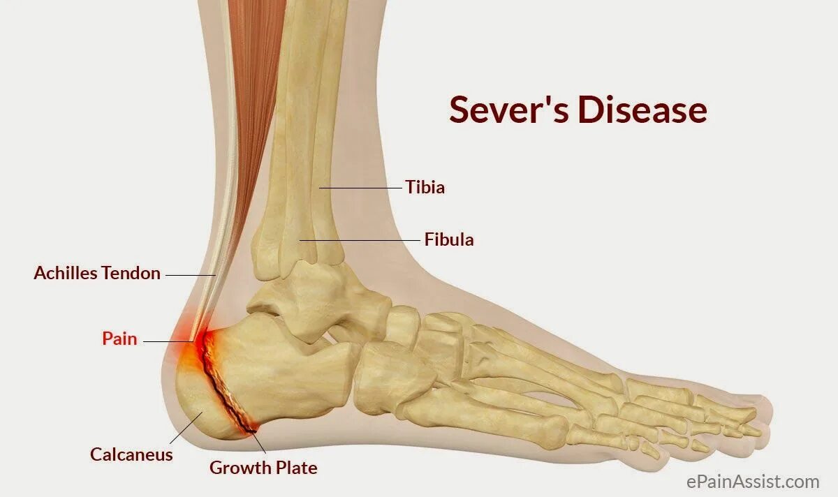 Пяточная кость фото как выглядит у человека Afbeeldingsresultaat voor apofyse calcaneus Heel pain, Disease, Severe