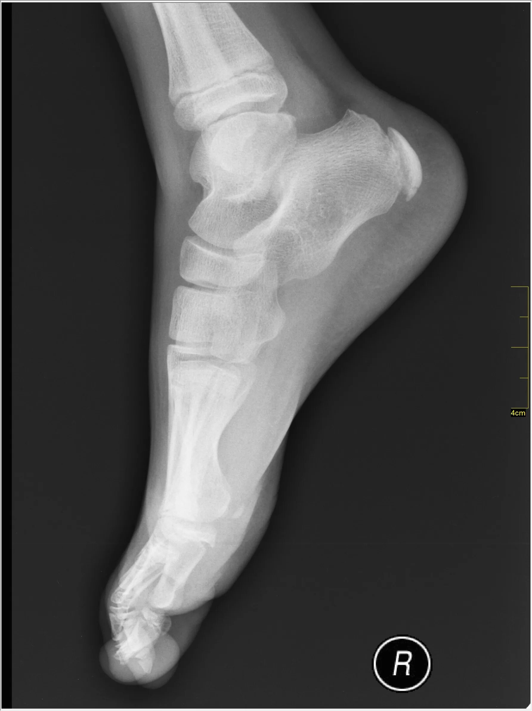 Пяточная кость фото как выглядит у человека File:Medical X-Ray imaging TKL07 nevit.jpg - Wikimedia Commons