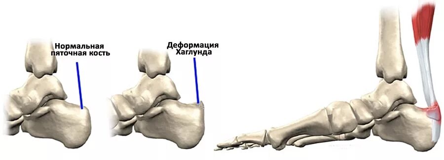 Пяточная кость фото как выглядит у человека Клиническая больница Деформация Хаглунда