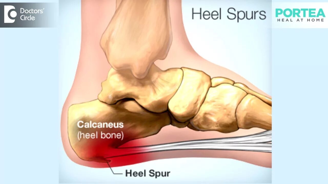 Пяточная кость фото как выглядит у человека What are the effects of untreated heel spurs? - YouTube