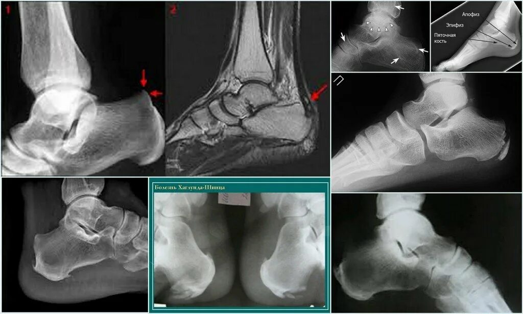 Пяточная кость фото как выглядит у человека Болезнь пяточной кости у детей