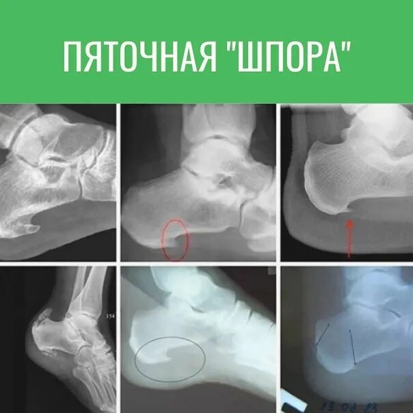 Пяточная кость фото как выглядит у человека Treatment of heel spurs. Do you feel pain when walking? Discomfort? Maybe you ha