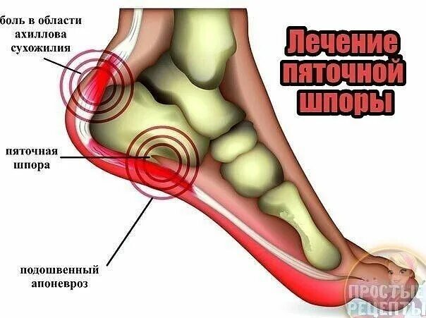 Пяточная шпора фото как выглядит Как я вылечила шпору за 3 дня! "Шпора" на пятке это очень больно, а... Интересны