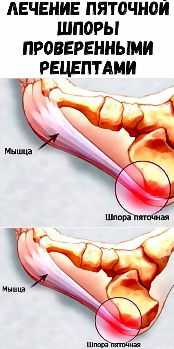 Пяточная шпора фото как выглядит Журнал для женщин Лечение, Лечение герпеса, Здоровье ног