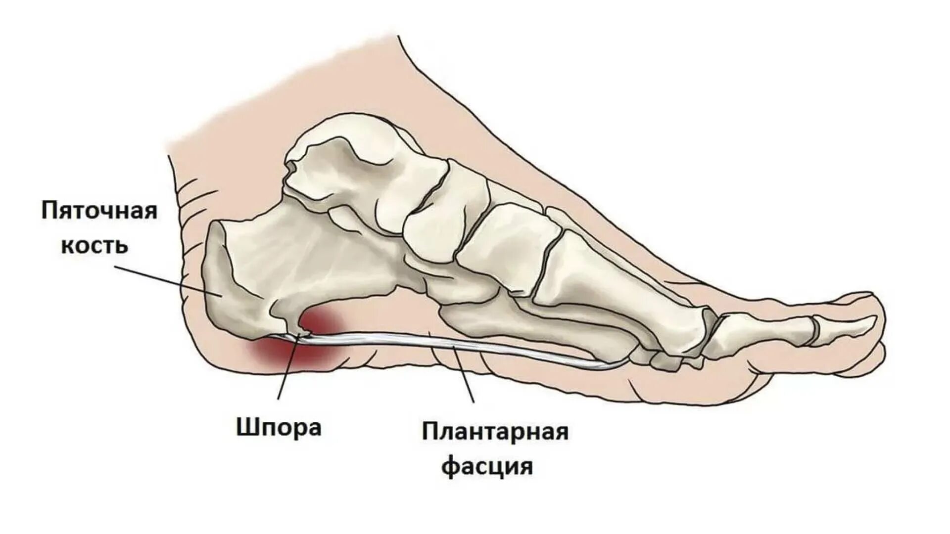 Пяточная шпора фото как выглядит на пятке Пяточная шпора Uniserv Medical Center