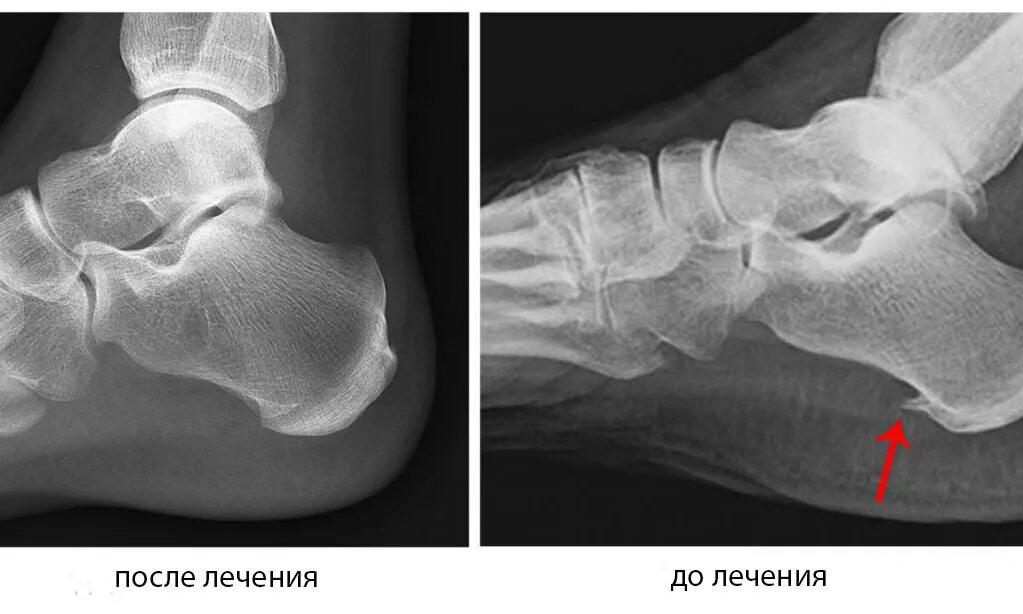 Пяточная шпора фото как выглядит на рентгене Вальгус