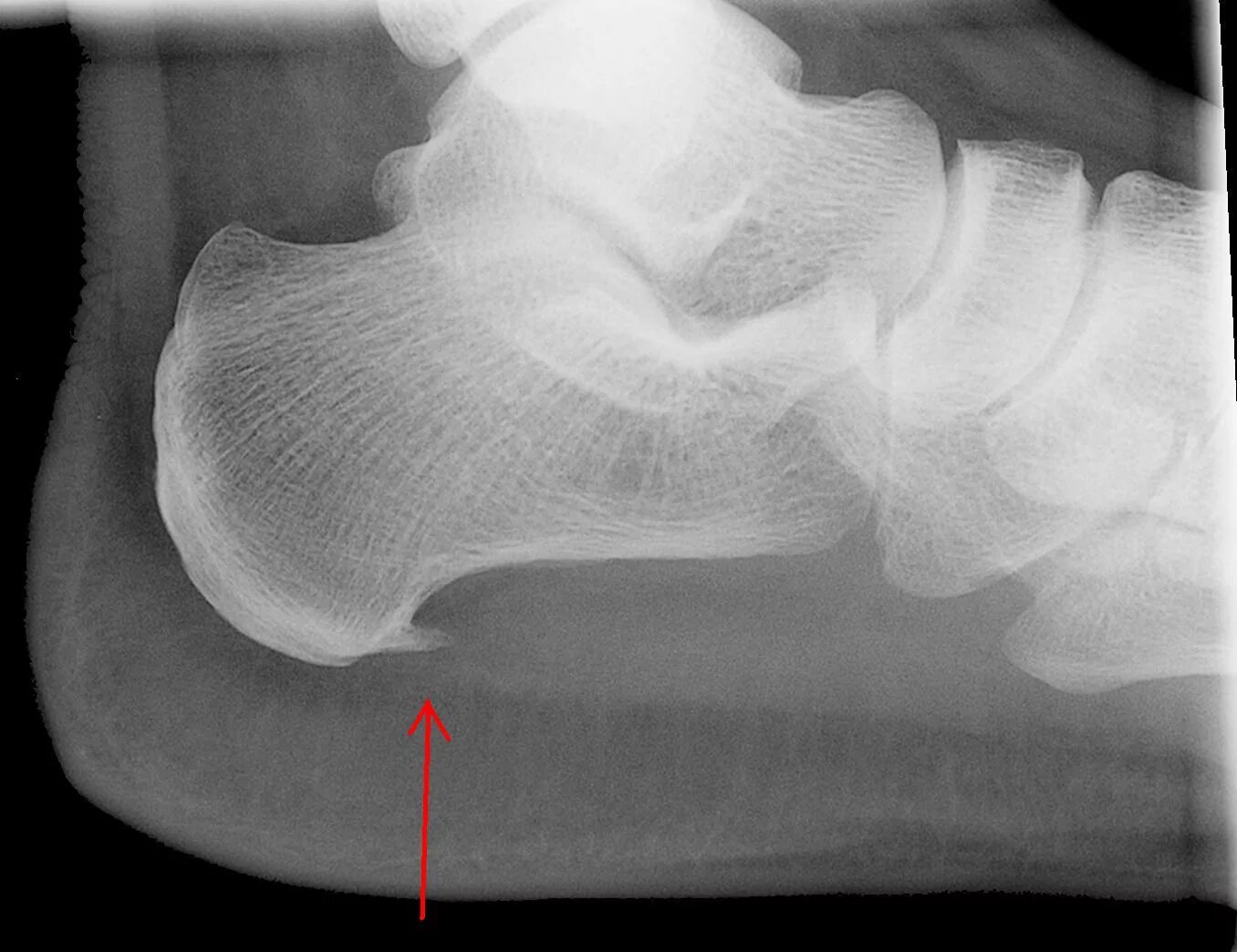 Пяточная шпора фото как выглядит на рентгене Файл:Projectional radiography of calcaneal spur.jpg - Википедия