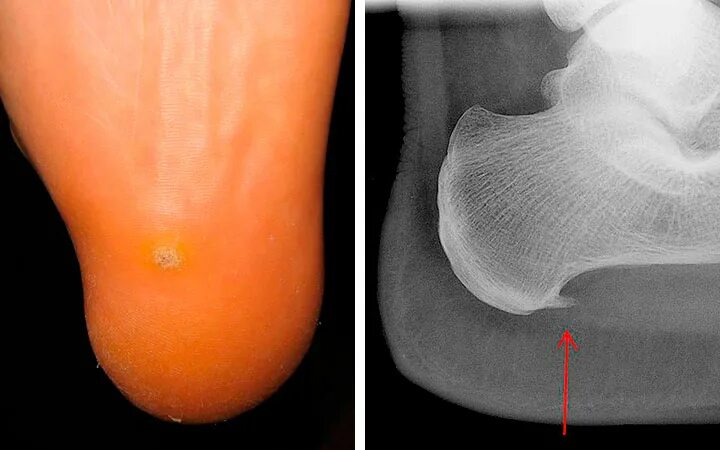 Пяточная шпора фото как выглядит на рентгене Пяточная шпора симптомы и лечение в домашних условиях