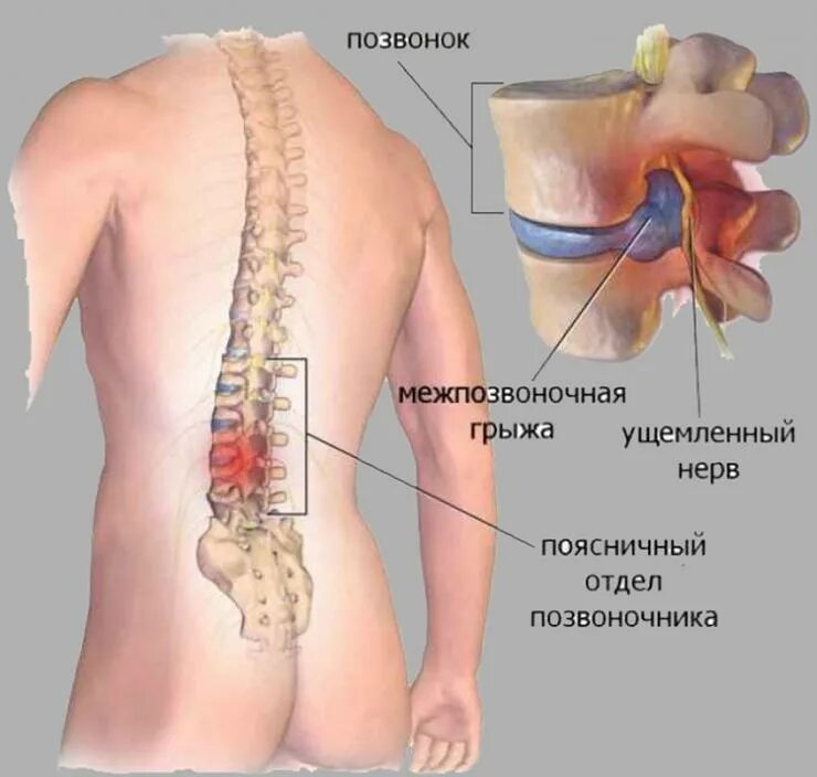 Пятый позвонок поясничного отдела фото Стопа не работает - что делать, отвислая стопа, повисшая стопа, висячая стопа, п
