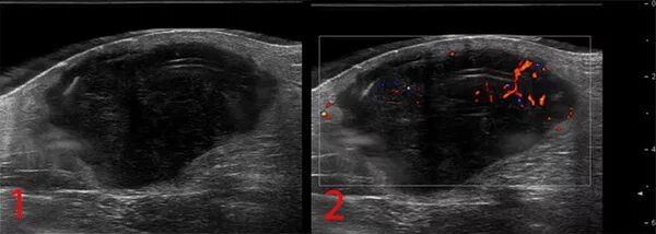 Рабдомиосаркома мягких тканей на узи фото Саркома - симптомы, фото, признаки, лечение, прогноз выживаемости