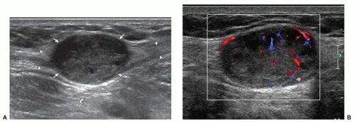 Рабдомиосаркома мягких тканей на узи фото Soft Tissue Masses Radiology Key