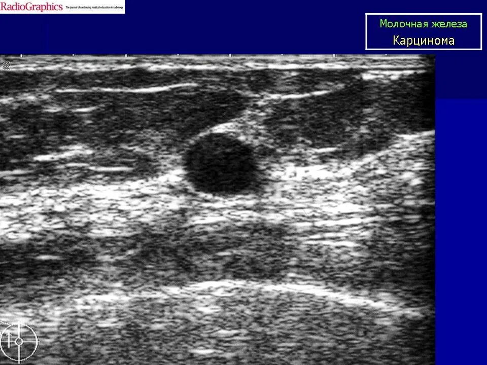 Рабдомиосаркома мягких тканей на узи фото Молочная железа. Онк. Зл. Рак. Саркома. Остеосаркома. + Портал радиологов